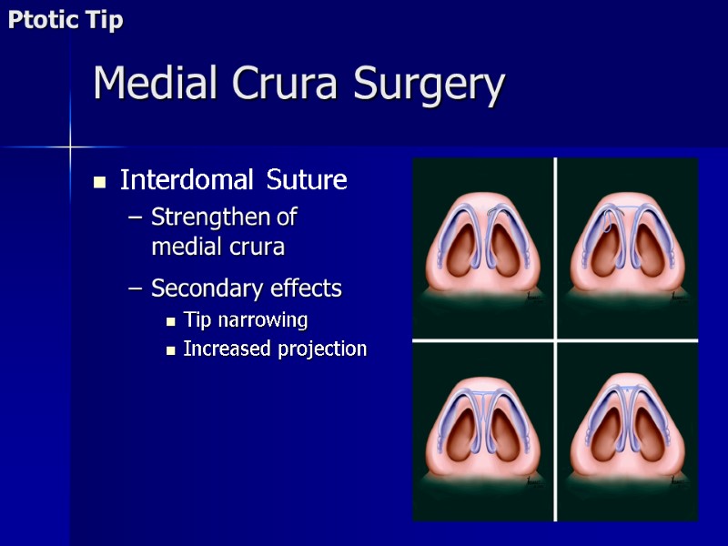 Interdomal Suture Strengthen of medial crura  Secondary effects Tip narrowing  Increased projection